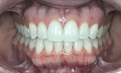 After treatment - Invisalign