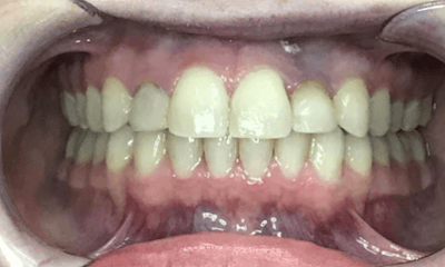 After treatment - Invisalign
