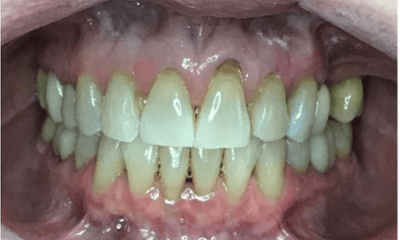 After treatment - Invisalign