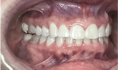 After treatment - Invisalign