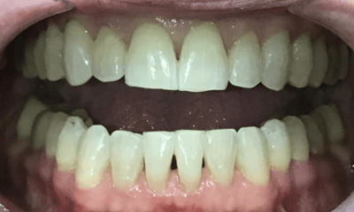 After treatment - Invisalign