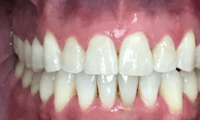 After treatment - Invisalign