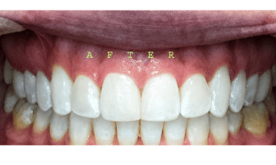 After treatment - Invisalign