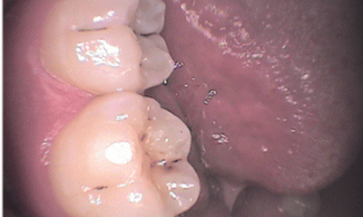 After treatment - Lower Tooth Composite Fillings
