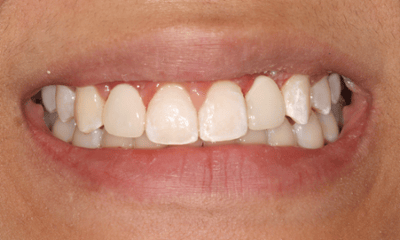 After treatment - Temporary Maryland Bridge and Crown