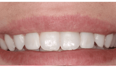 After treatment - Peg Lateral Restoration