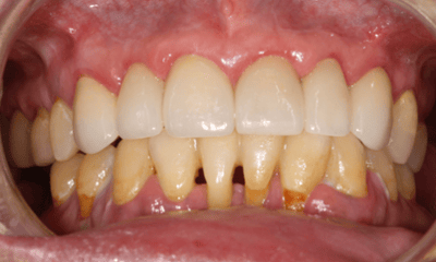 After treatment - Crowns