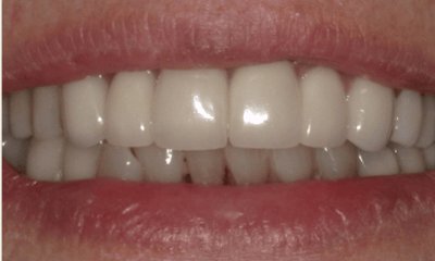 After treatment - Smile Makeover Crown