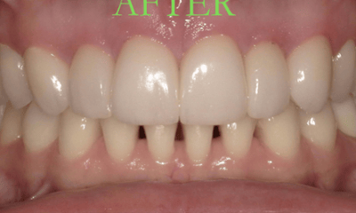 After treatment - Veneers