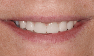 After treatment - Smile Transformation