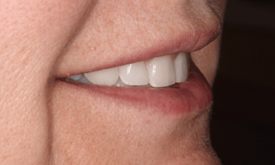 After treatment - Smile Transformation 
