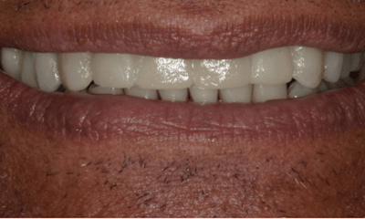 After treatment - Trial Smile Makeover