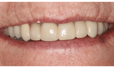 After treatment - Upper Bridge Rehabilitation