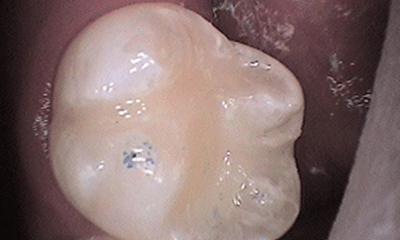 After treatment - Upper Tooth Composite Fillings