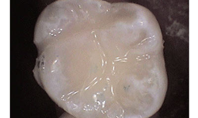 After treatment - Upper Tooth Composite Fillings