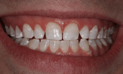 After treatment - Whitening