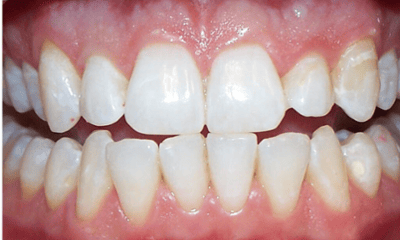 After treatment - Whitening