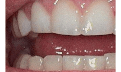 After treatment - Veneers