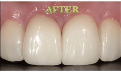 After treatment - Veneers