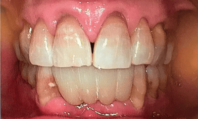 After treatment - Lower Implant Bridge