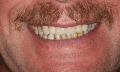 After treatment - Crowns & Implant 