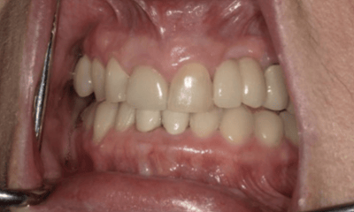 After treatment - Invisalign & Crown