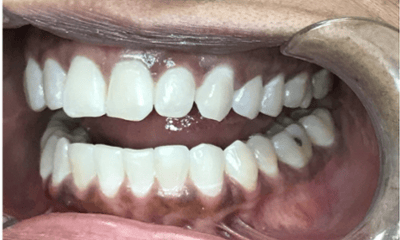 After treatment - Invisalign Black Triangle