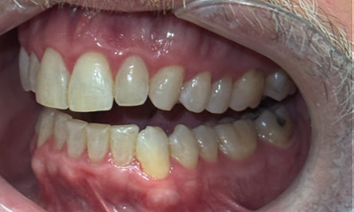 After treatment - Invisalign & Bonding