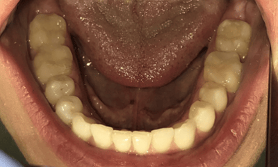 After treatment - Invisalign Crowding & Single Tooth Crossbite