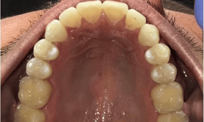 After treatment - Invisalign Crowding