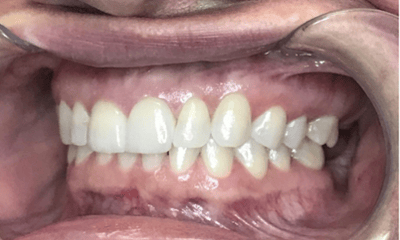 After treatment - Invisalign & Crowns Combo