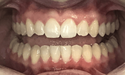 After treatment - Invisalign Rotation Crossbite