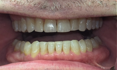 After treatment - Invisalign, Whitening, & Bonding