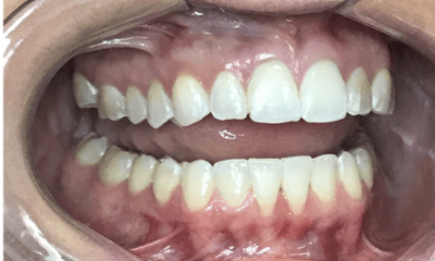 After treatment - Invisalign & Whitening