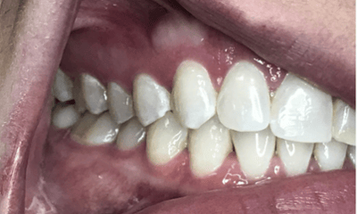 After treatment - Invisalign & Whitening