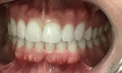 After treatment - Invisalign