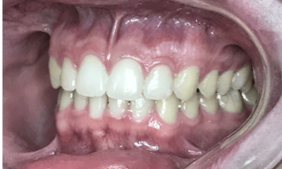 After treatment - Invisalign