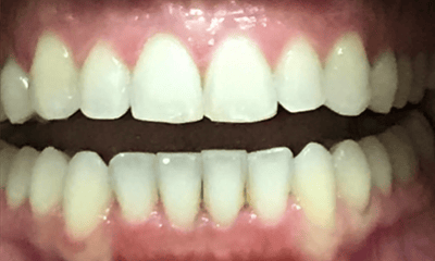 After treatment - Invisalign