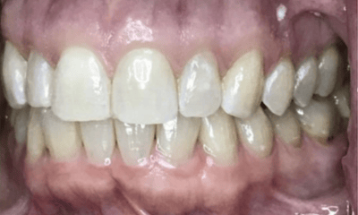 After treatment - Invisalign