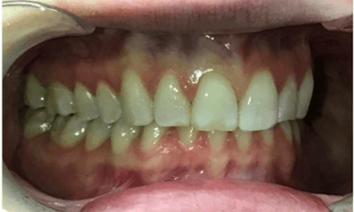 After treatment - Invisalign