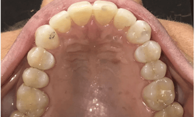 After treatment - Invisalign