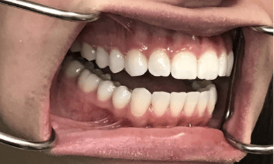 After treatment - Invisalign