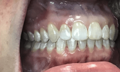 After treatment - Invisalign