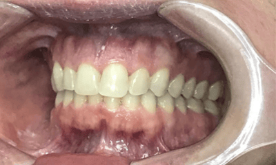 After treatment - Invisalign