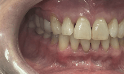 After treatment - Invisalign
