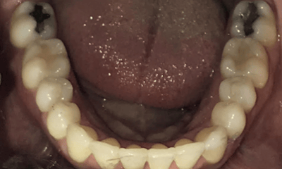 After treatment - Invisalign & Anterior Bonding 