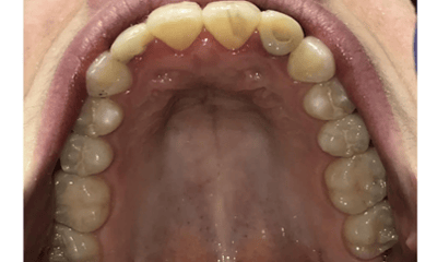 After treatment - Invisalign