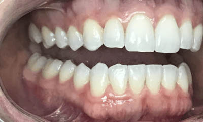 After treatment - Invisalign