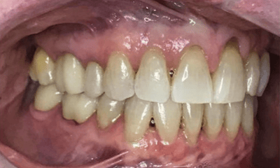 After treatment - Invisalign