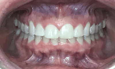 After treatment - Invisalign